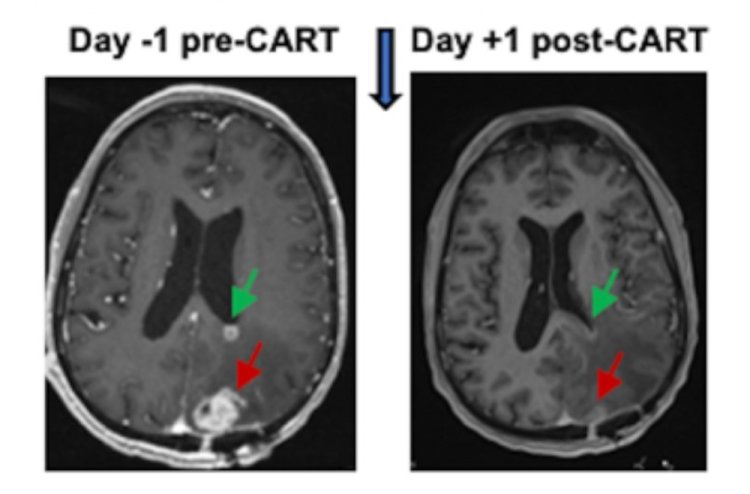 New Immune-Focused Therapy Shrinks Aggressive Brain Tumors