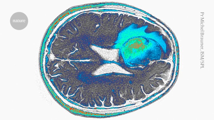 Deadly brain cancer shrinks after CAR-T therapy — but for how long is unclear